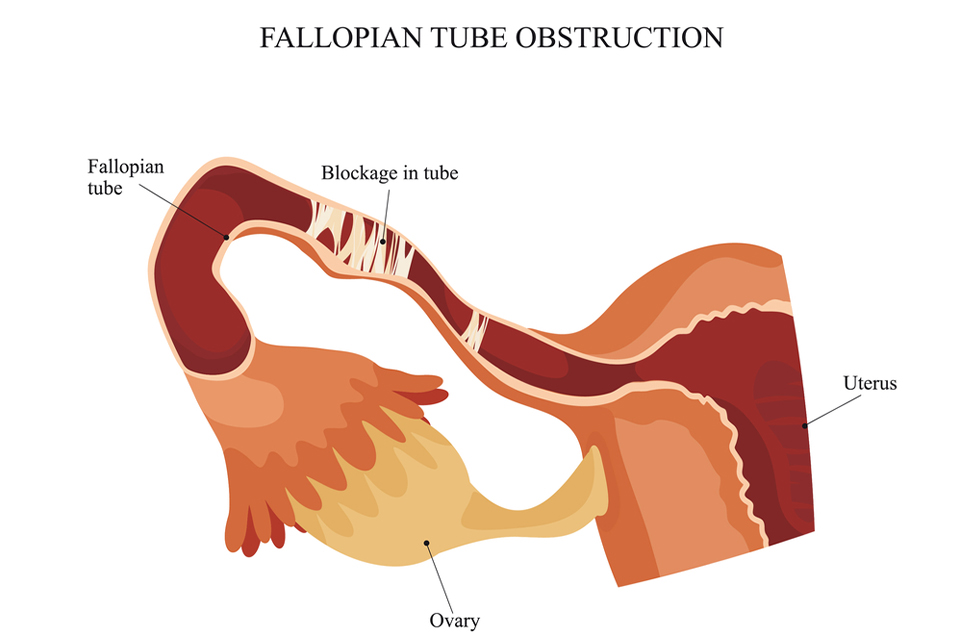 Blocked Fallopian Tubes