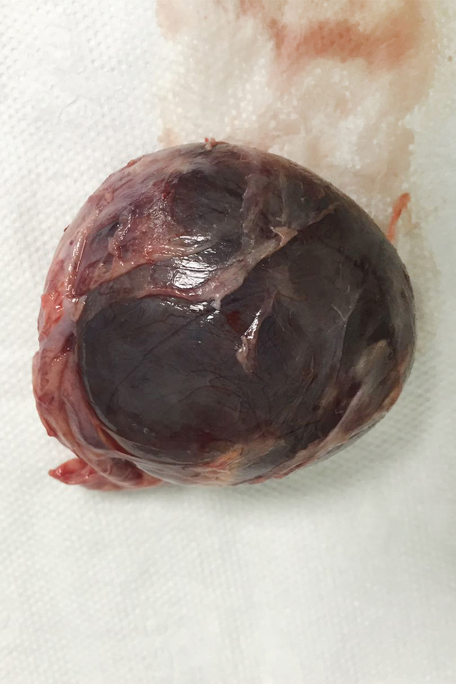 Ovarian Cyst